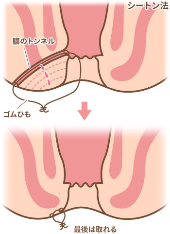 シートン