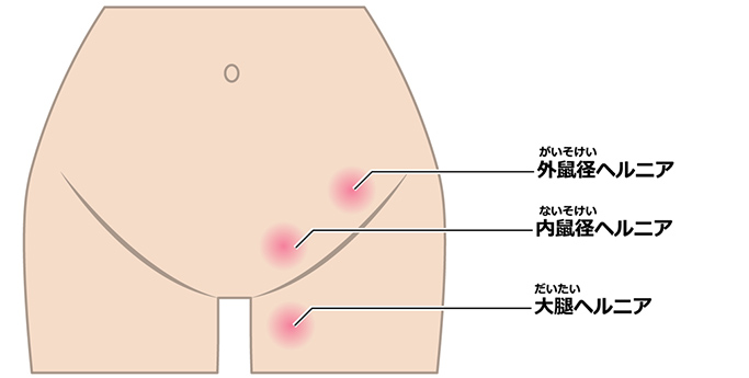 鼠経ヘルニアには3種類あります