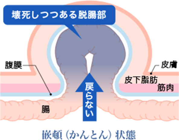 鼠経ヘルニアは放置しても大丈夫？