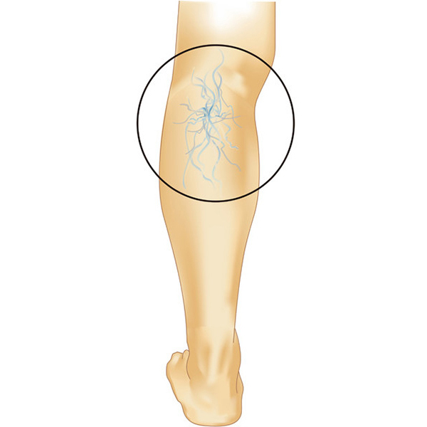 下肢静脈瘤 足の血管が浮き出る ボコボコの血管 足のむくみ 水戸市東水戸のかねこ消化器内視鏡肛門外科クリニック水戸院