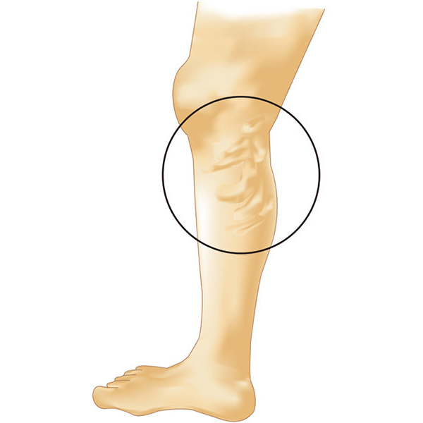 下肢静脈瘤 足の血管が浮き出る ボコボコの血管 足のむくみ 水戸市東水戸のかねこ消化器内視鏡肛門外科クリニック水戸院
