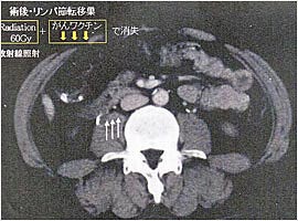 自家がんワクチン