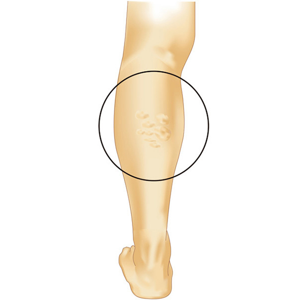 下肢静脈瘤 足の血管が浮き出る ボコボコの血管 足のむくみ 水戸市東水戸のかねこ消化器内視鏡肛門外科クリニック水戸院