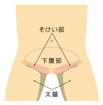 鼠径ヘルニア 外鼠径ヘルニア 内鼠径ヘルニア 大腿ヘルニア 水戸市東水戸のかねこ消化器内視鏡肛門外科クリニック水戸院