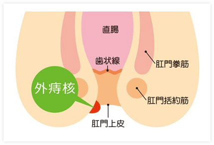 外痔核