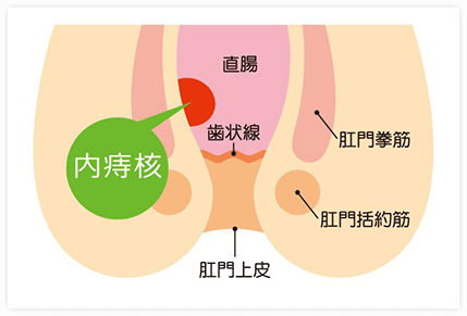 内痔核