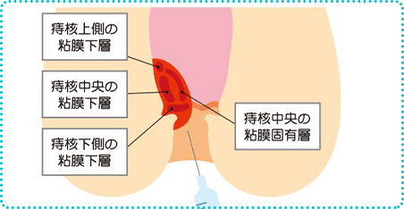 ジオン注射（ALTA療法）