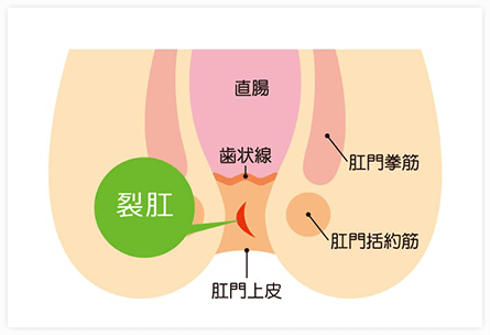 切れ痔