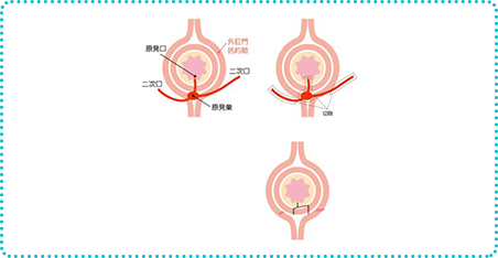 瘻管切開開放術