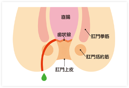 痔ろう